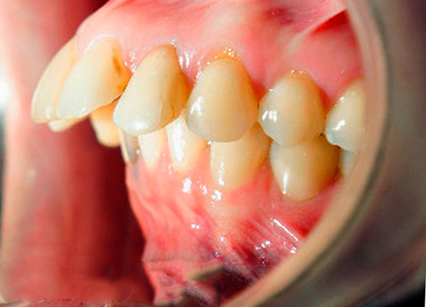 A foto mostra um exemplo de mordida distal horizontal (2ª série, 1ª subclasse de acordo com a classificação de Engle).