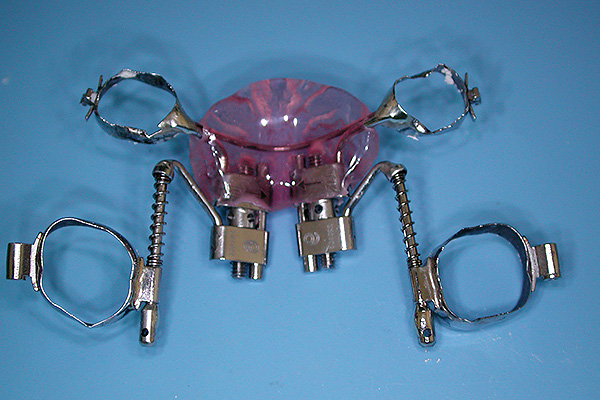 Aparelho ortodôntico Distal Jet