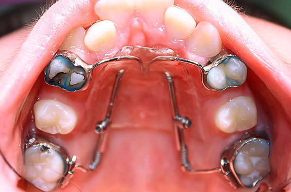 Jato distal na cavidade oral do paciente.