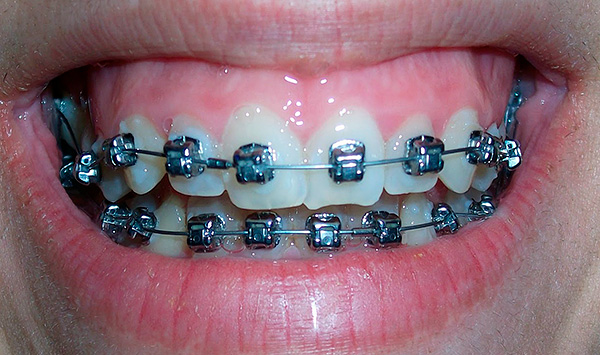 O uso de um sistema de braquetes é geralmente a etapa final no tratamento de uma mordida distal.