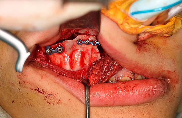 A cirurgia ortognática ajuda a corrigir a mordida nas situações mais difíceis ...