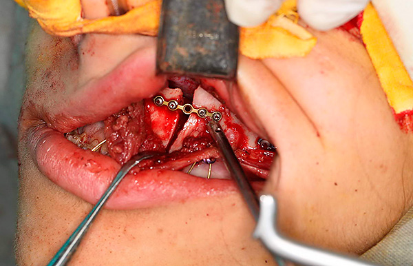 Com medo da cirurgia, alguns pacientes recusam a cirurgia ortognática, mas, neste caso, o perfil característico da face não pode ser alterado.