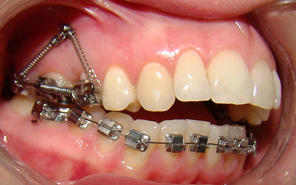 Com uma mordida aberta, existe um espaço entre a dentição.