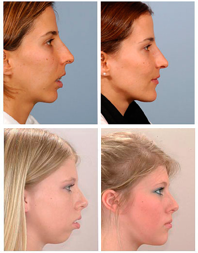 As fotografias mostram como o perfil do rosto pode parecer antes e depois da correção da picada distal.