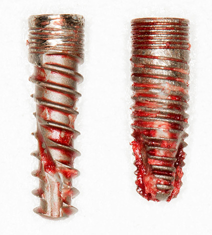 Implantes dentários removidos da mandíbula