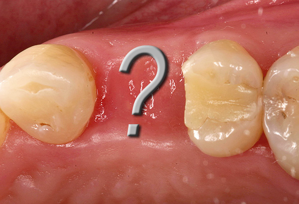 Existem certas contra-indicações para a instalação de implantes, bem como para qualquer intervenção cirúrgica.