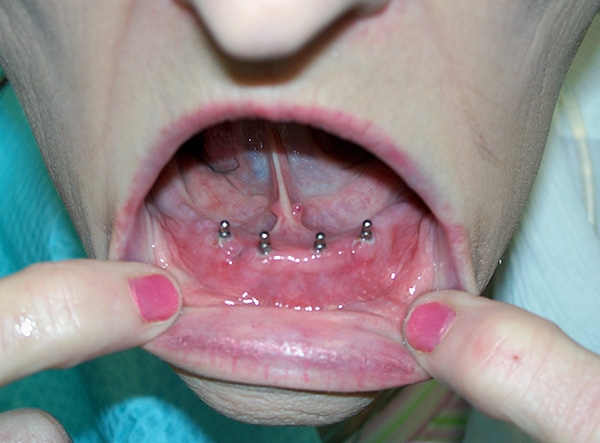 Muitas contra-indicações para a instalação de implantes são relativas e nem sempre interferem na restauração de um sorriso e na capacidade de mastigar normalmente.