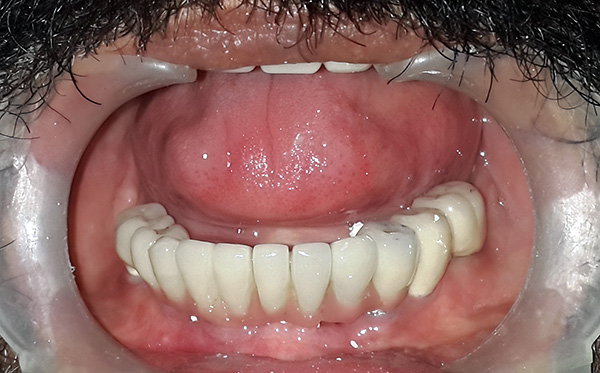 Um exemplo de restauração da dentição em implantes