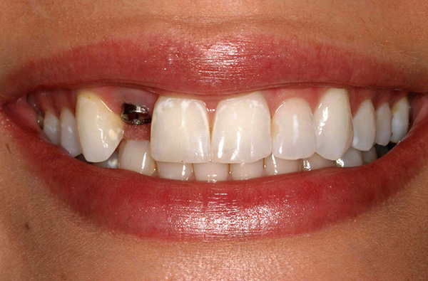 Muitas pessoas consideram a colocação de implantes um procedimento perigoso e perigoso, mas é realmente assim?