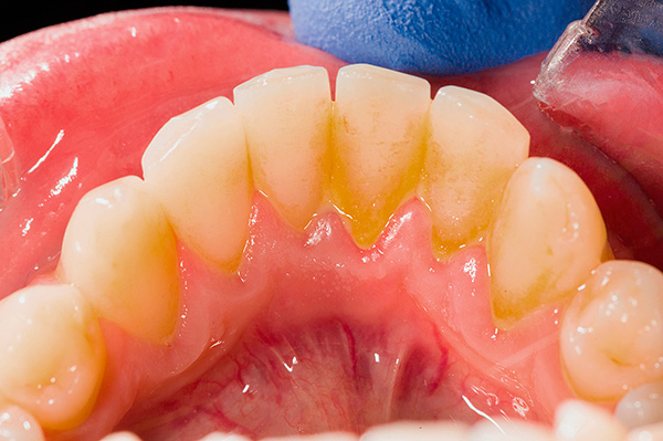 A falta de higiene bucal pode levar rapidamente à formação de depósitos dentários abundantes (placa e tártaro).