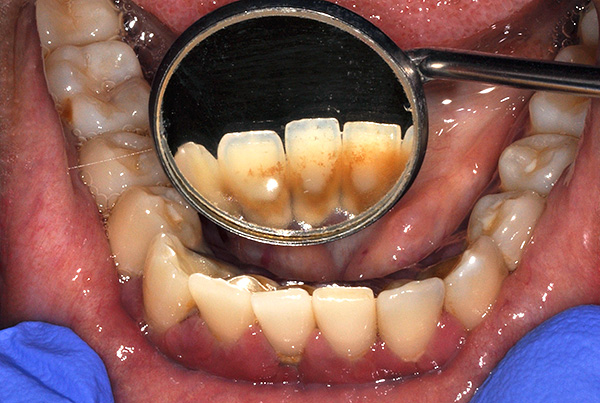 O acúmulo de placa e pedra no futuro pode levar a periodontite e mobilidade não apenas de dentes nativos, mas também de implantes.