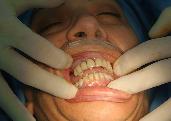 Em alguns casos, os implantes também podem ser instalados usando anestesia geral (anestesia).