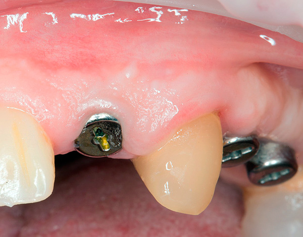 A porcentagem de sobrevivência nesses implantes atinge 99,6%, o que é um indicador muito bom.