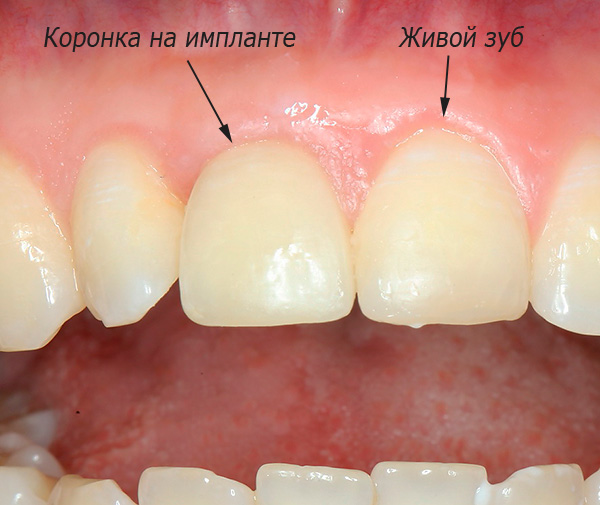 Nesta foto, você pode ver o resultado das próteses do dente da frente no implante XiVE.