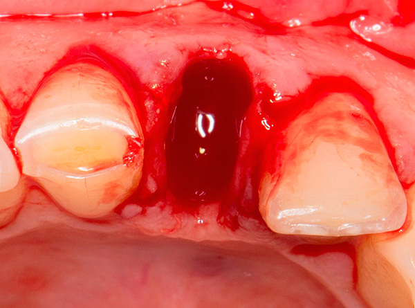 Em alguns casos, usando implantes XiVE, o chamado implante imediato pode ser realizado colocando-os no poço de um dente que acabou de ser removido.