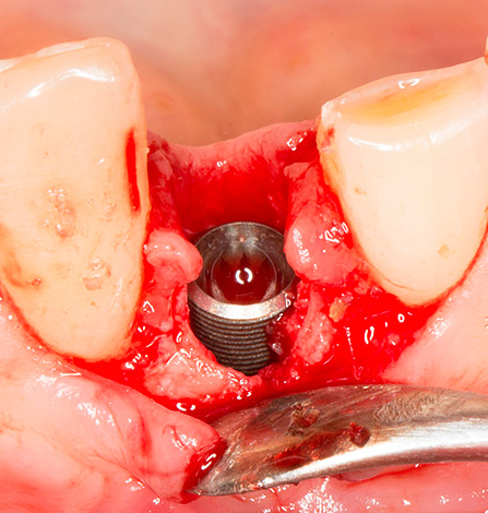 O implante é inserido no orifício do dente extraído ...