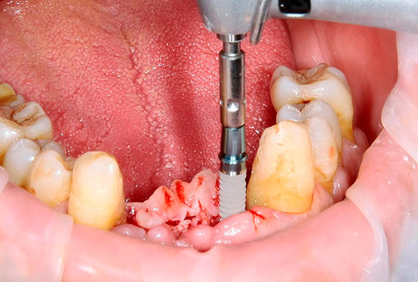 O padrão de rosca dos implantes XiVE impede que eles encravem na mandíbula.