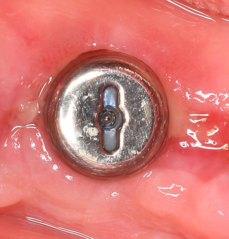 Um exemplo de implante bem implantado (um formador de gengiva é instalado no exterior).