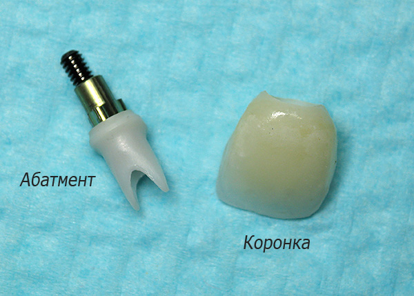 Uma contribuição significativa para o custo total de próteses em implantes é feita pelo pilar e coroa permanentes.