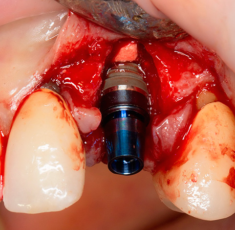 A qualidade do implante dentário é feita e a forma como o seu design é pensado, em muitos aspectos, depende de se enraizar na mandíbula ou se arrancar.