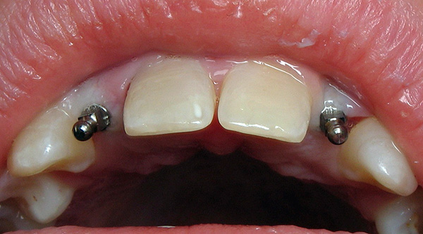 A vida útil dos mini-implantes é bastante comparável à vida útil das opções clássicas.