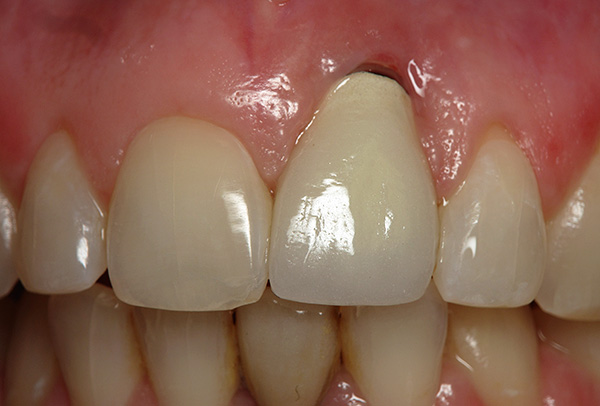 Problemas com implantes podem ocorrer mesmo muitos anos após a instalação.