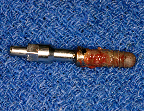 Implante dentário removido da mandíbula