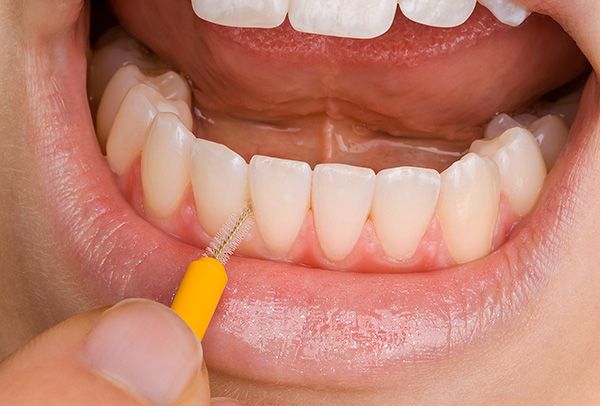 Em vez de usar fio dental, é útil usar pincéis interdentais.