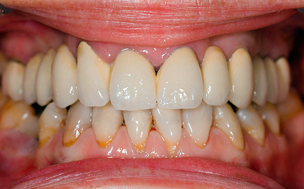 Se você não prestar atenção suficiente à higiene bucal, a vida útil dos implantes dentários poderá ser muito curta.