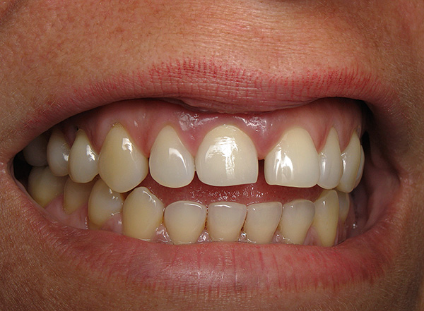 Ao seguir uma série de regras simples, você pode estender significativamente a vida útil dos implantes ...
