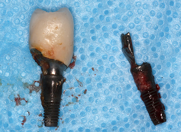 Infelizmente, os implantes dentários às vezes realmente precisam ser removidos.