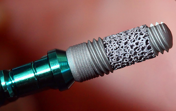 Algumas empresas dão uma garantia vitalícia para os implantes fabricados.