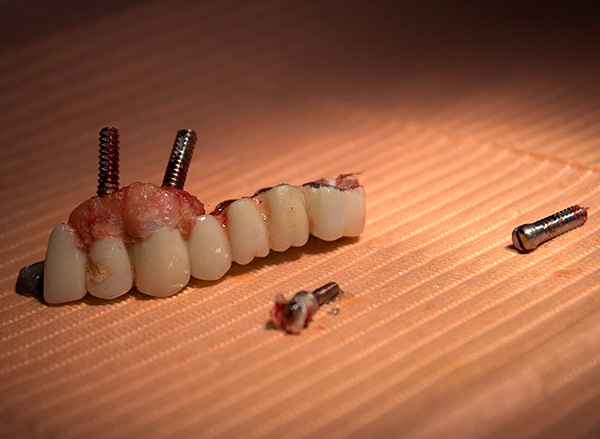 Na maioria das vezes, os implantes são rejeitados precisamente devido a erros cometidos pelo médico durante a operação.