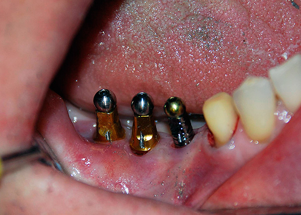 A vida útil dos implantes dentários mais caros e de alta qualidade pode ser muito pequena se o médico cometer erros ao instalá-los ...