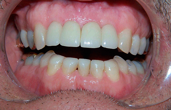 A implantação dentária no exterior é realizada há mais de meio século, o que permite acompanhar as estatísticas em um intervalo de tempo suficientemente grande.