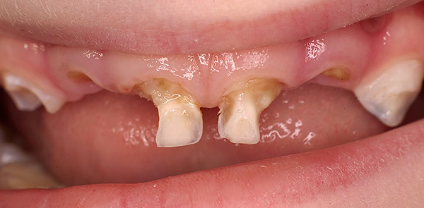Cárie de dentes decíduos