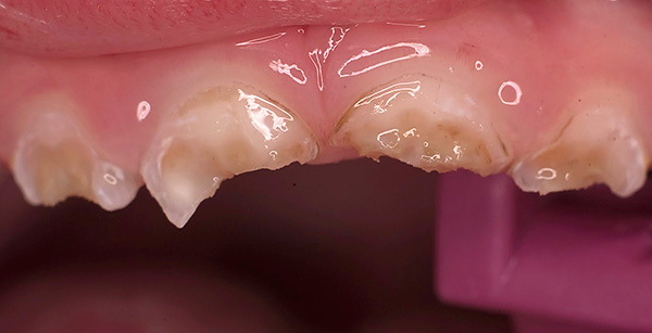 Sem cuidados bucais adequados, a situação com os dentes de leite pode rapidamente se tornar desastrosa ...