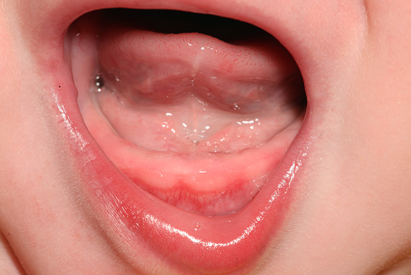 Há situações em que os dentes de leite do bebê não surgem por um longo tempo.