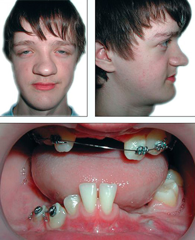 Disostose craniana clavicular