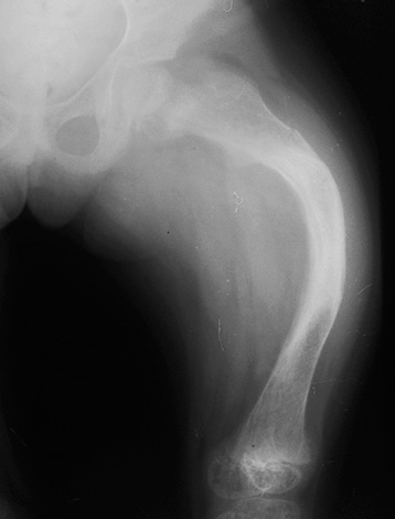 A falta de vitamina D no corpo da criança afeta a condição de todo o esqueleto do bebê, afetando também a formação de mandíbulas e dentes.