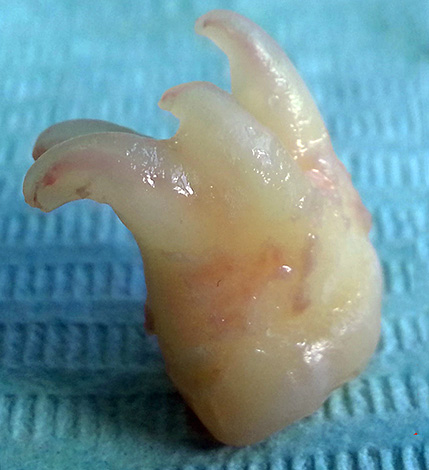 Dilaceração - curvatura das raízes do dente.