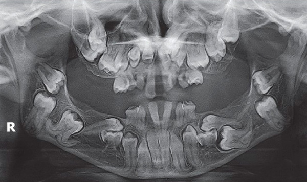 A posição anormal das gemas dos dentes pode ser detectada com antecedência usando um raio-x.
