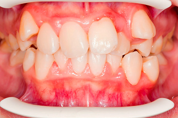 Distopia dos dentes (sua localização não está no seu lugar normal).