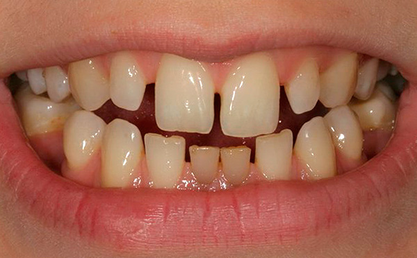 A foto mostra um exemplo de microdentia.