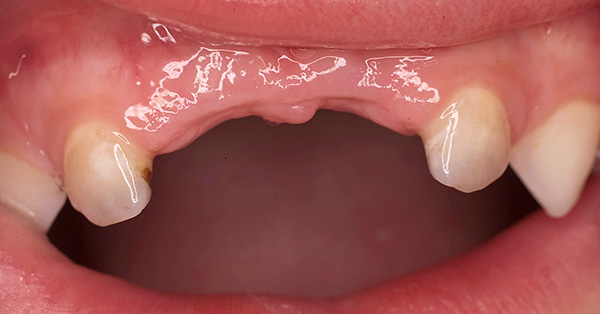 A perda prematura de dentes decíduos pode afetar adversamente o desenvolvimento de uma mordida permanente em uma criança.