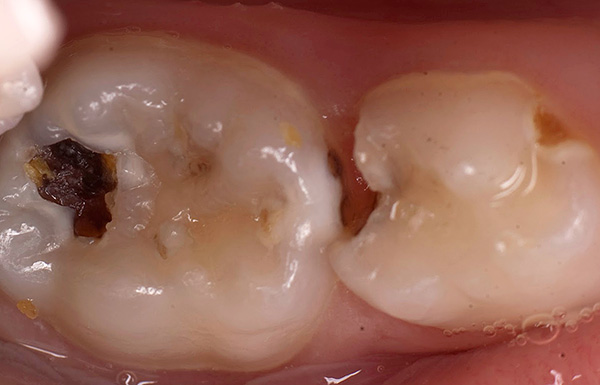 Com a perda prematura de um dente de leite para mascar, podem ocorrer alterações negativas na posição de um dente adjacente a ele, bem como um antagonista na mandíbula oposta.