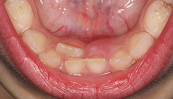 Dente supercompleto na mandíbula inferior.