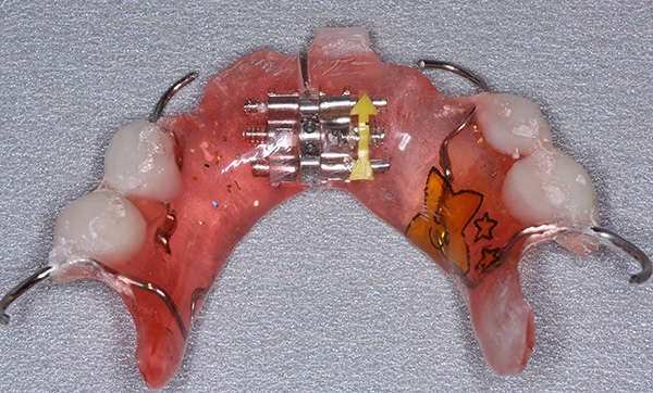 Um aparelho com um parafuso em expansão e dentes artificiais para correção de uma mordida de leite.