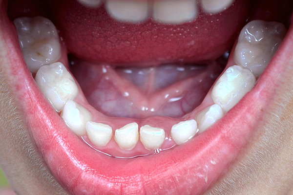 Há 10 dentes em uma mordida cheia de leite na mandíbula inferior (e o mesmo número na parte superior).