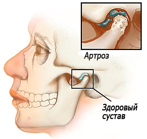A imagem mostra esquematicamente a artrose da articulação temporomandibular ...